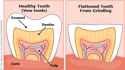 Bruxism Treatment Consultation