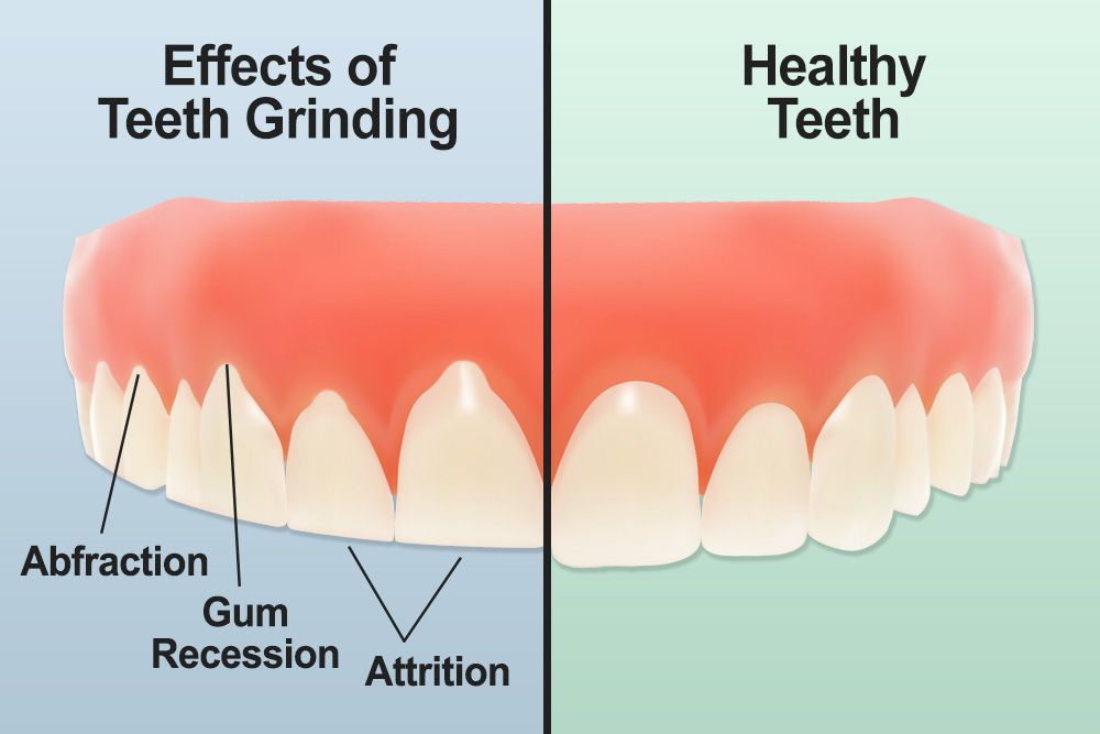 Night Guard for Bruxism