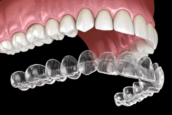 Clear aligners treatment