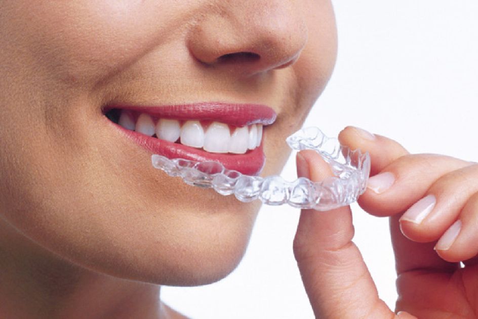 Transparent aligners for straightening teeth