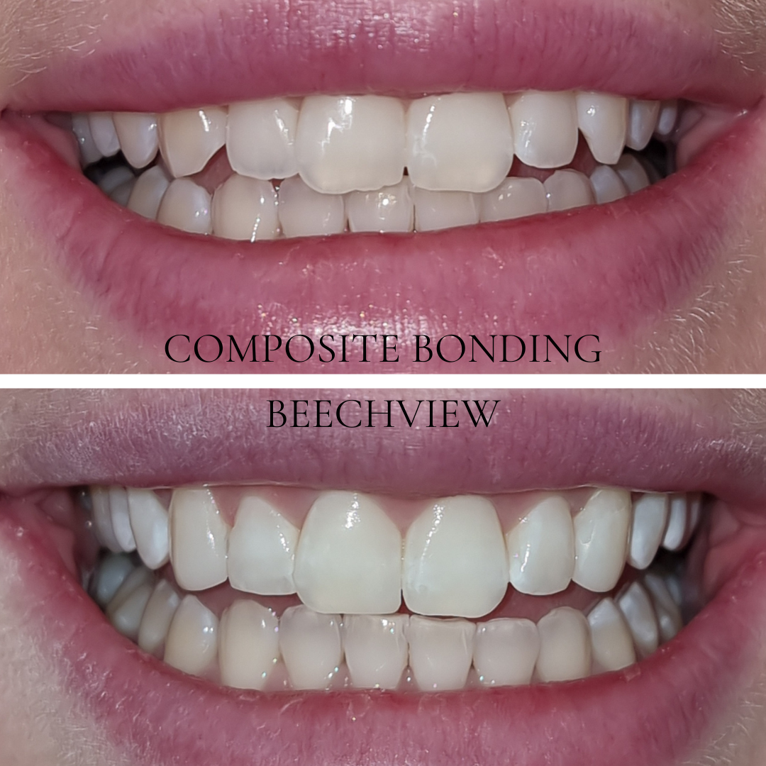 Composite bonding cosmetic dental treatment