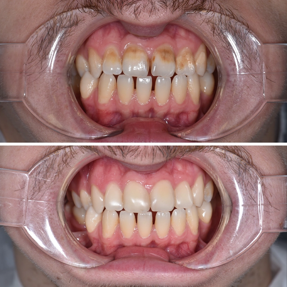 Composite bonding for chipped and uneven teeth
