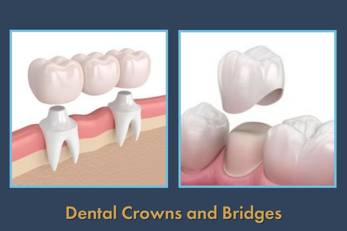 Dental crown treatment for restoring damaged teeth