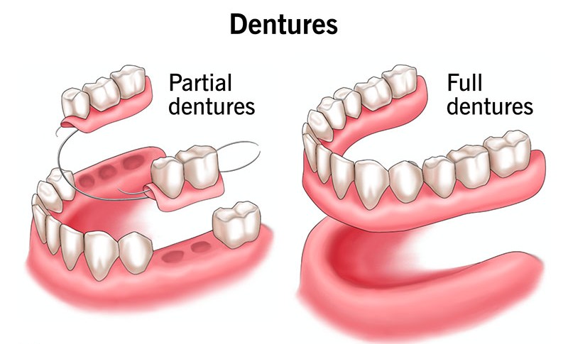 Custom dentures for replacing missing teeth