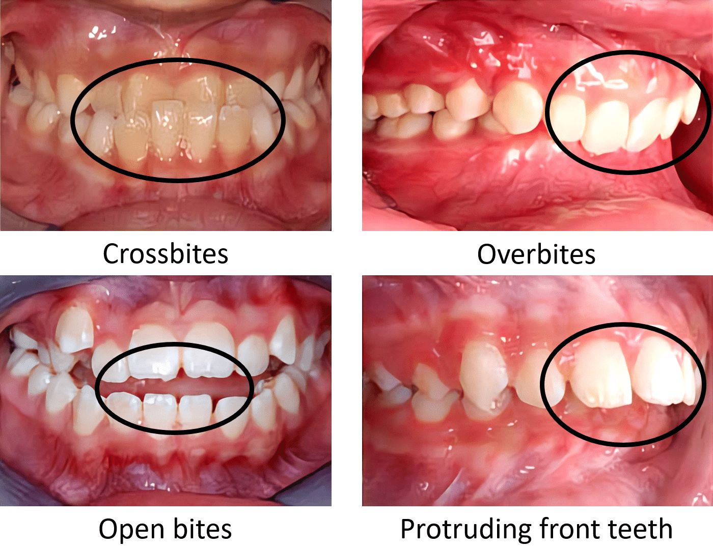 Exploring Interceptive Orthodontics