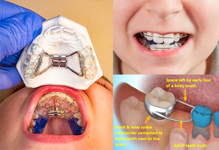 Early Orthodontic Treatment for Children