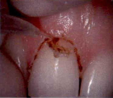 Laser Dentistry image 3