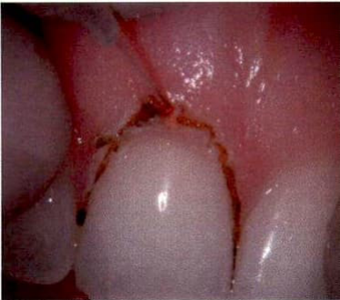 Tissue management for restorations