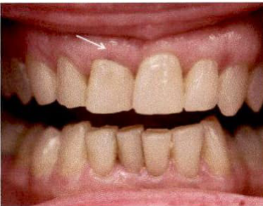 Clinical example laser 6