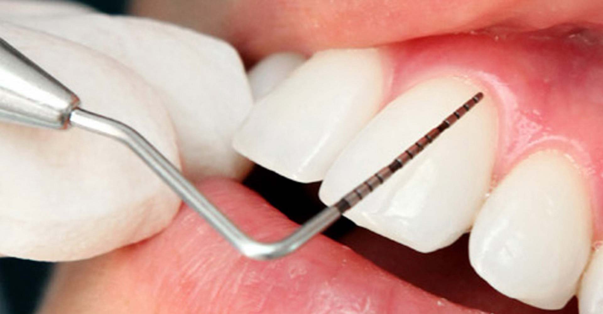 Professional periodontal evaluation and gum care