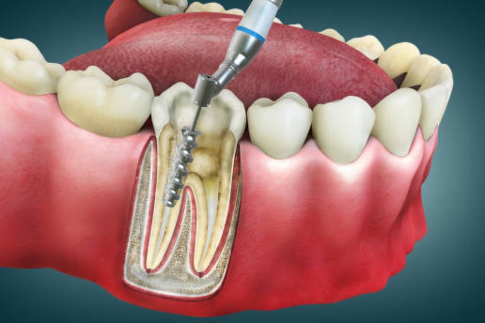 Root canal treatment for infected tooth