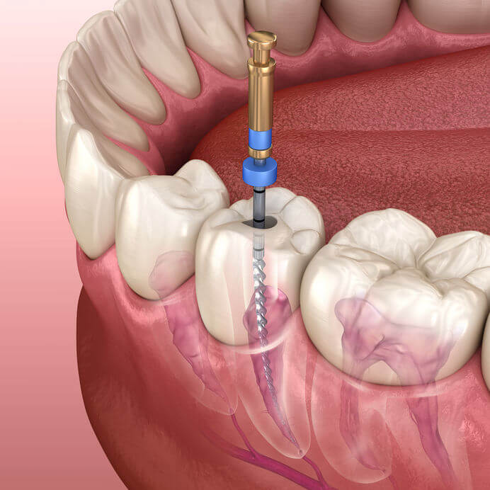 Professional root canal procedure and tooth preservation