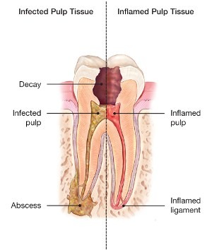 Root canal consultation and dental care treatment