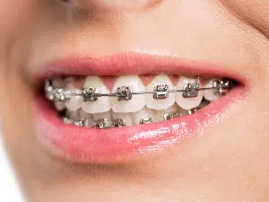 Cosmetic orthodontics consultation