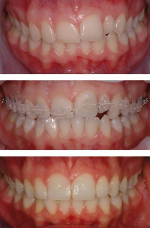 Short-term orthodontics smile improvement