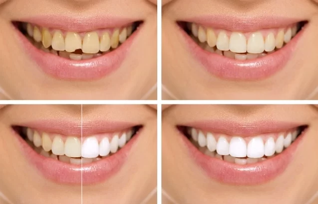 Smile makeover cosmetic dentistry result