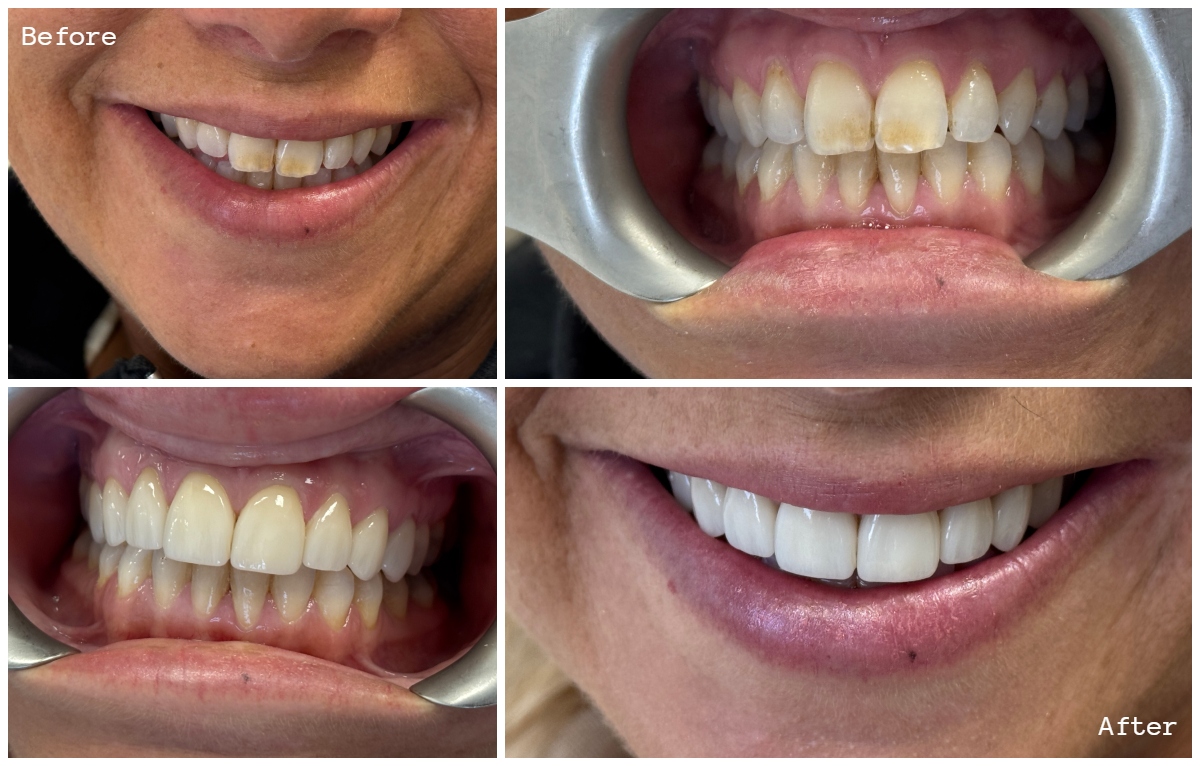 Customized smile makeover treatment