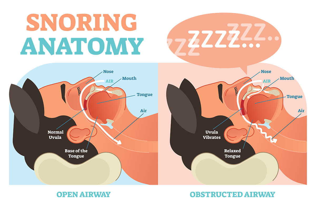 Airway-related snoring concerns