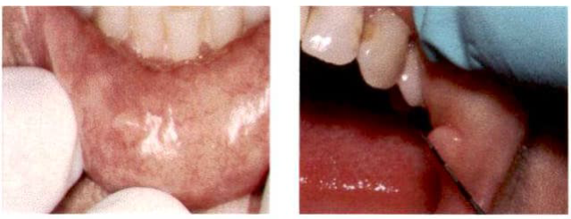 Surgical excision clinical photo 1