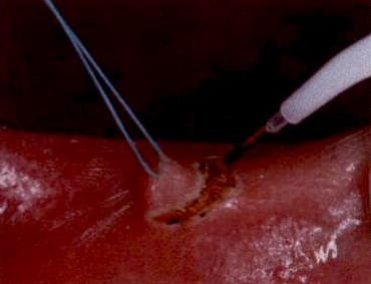 Surgical excision clinical photo 2