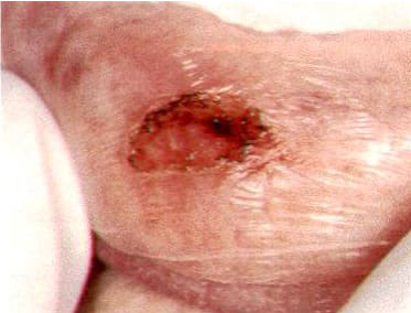 Surgical excision clinical photo 3