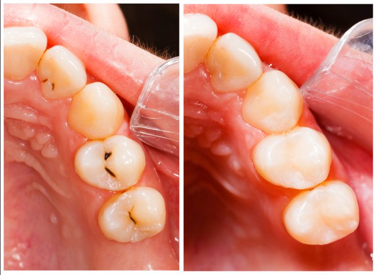 Tooth-coloured fillings restorative dental treatment