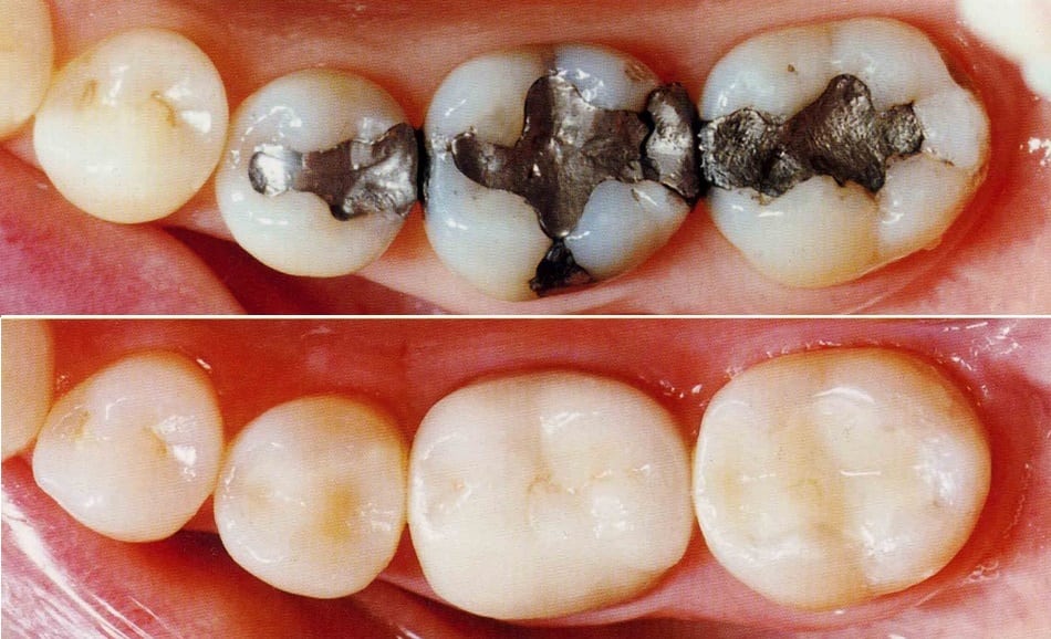 Natural-looking tooth-coloured filling restoration