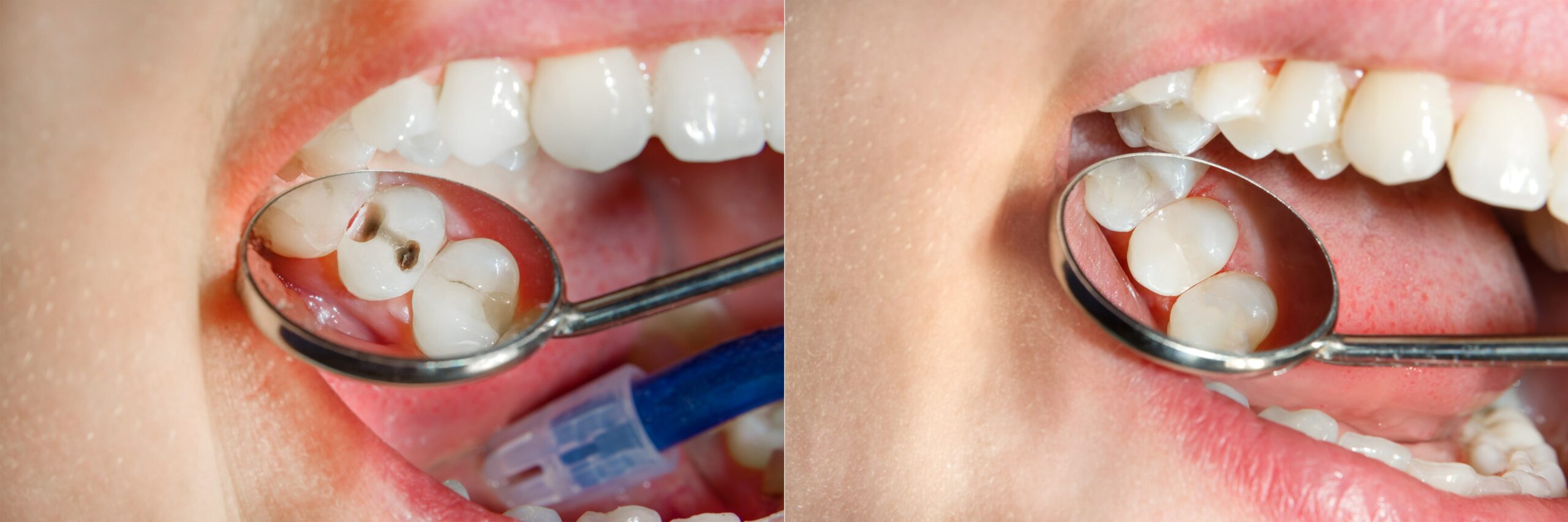 Tooth-coloured fillings consultation and repair