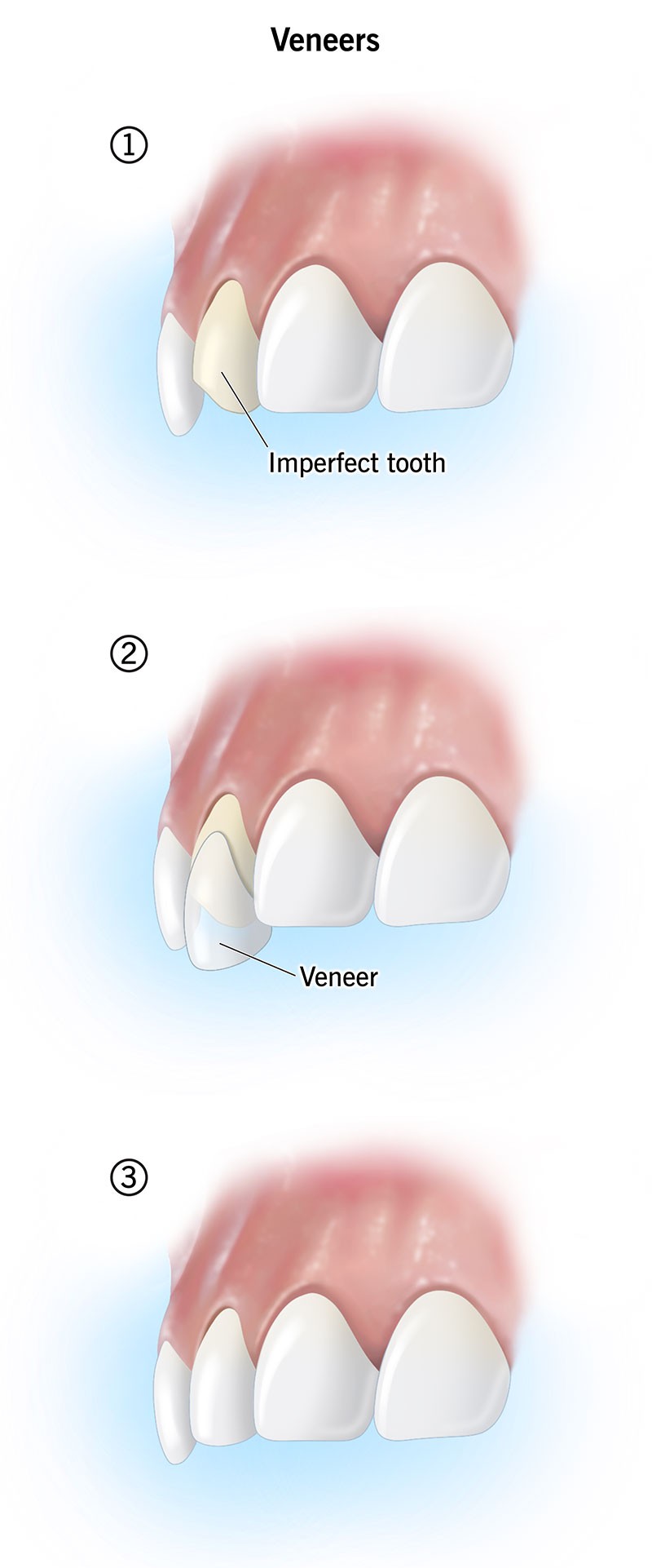 Dental veneers cosmetic smile enhancement