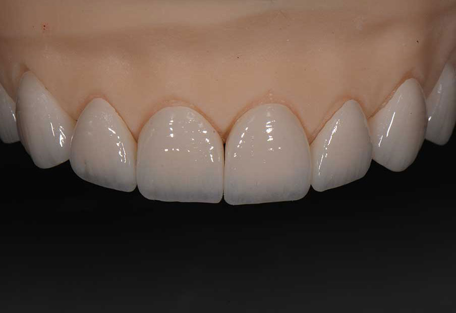 Dental veneers consultation and smile transformation