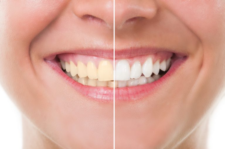 Brighter smile after teeth whitening