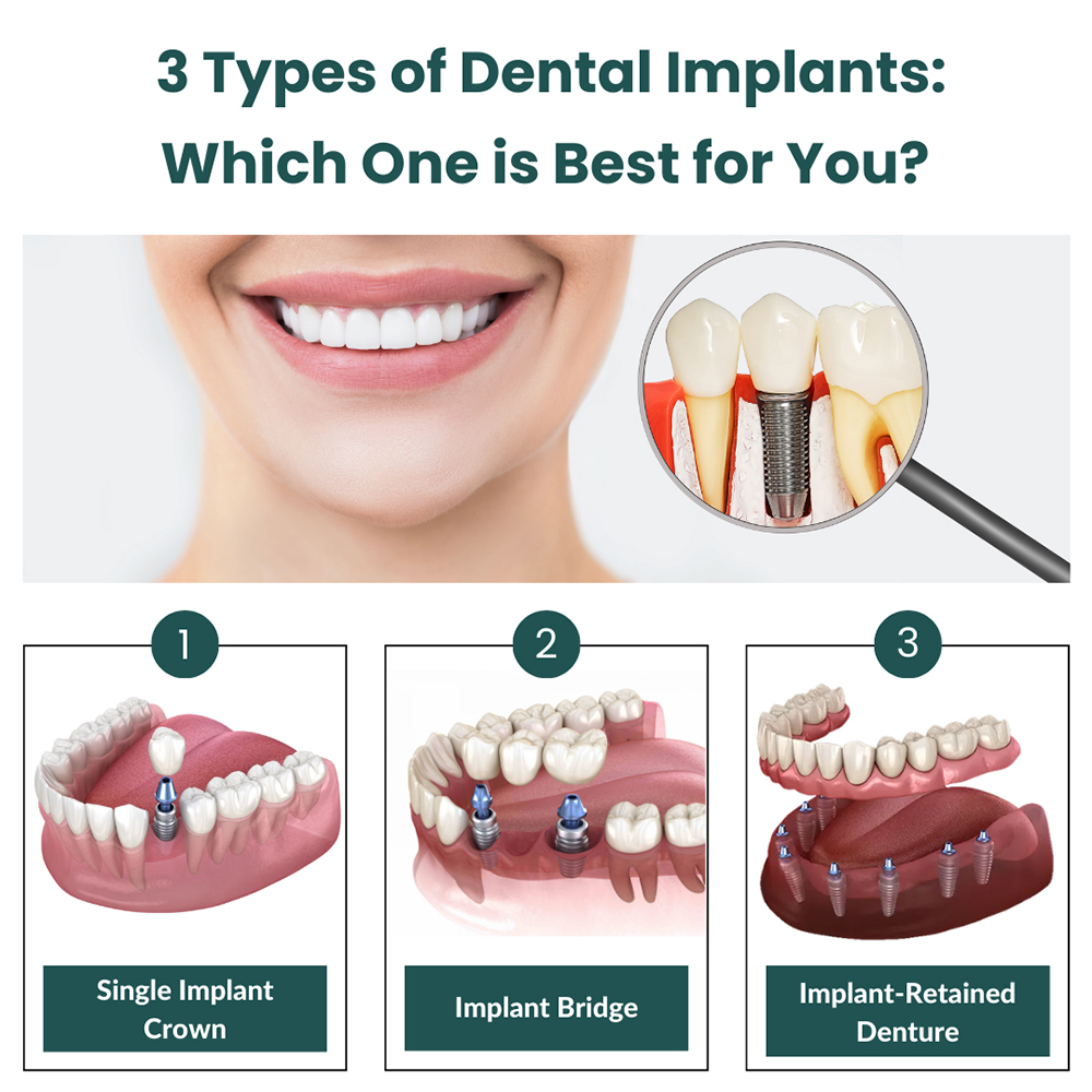Dental Implant Structure