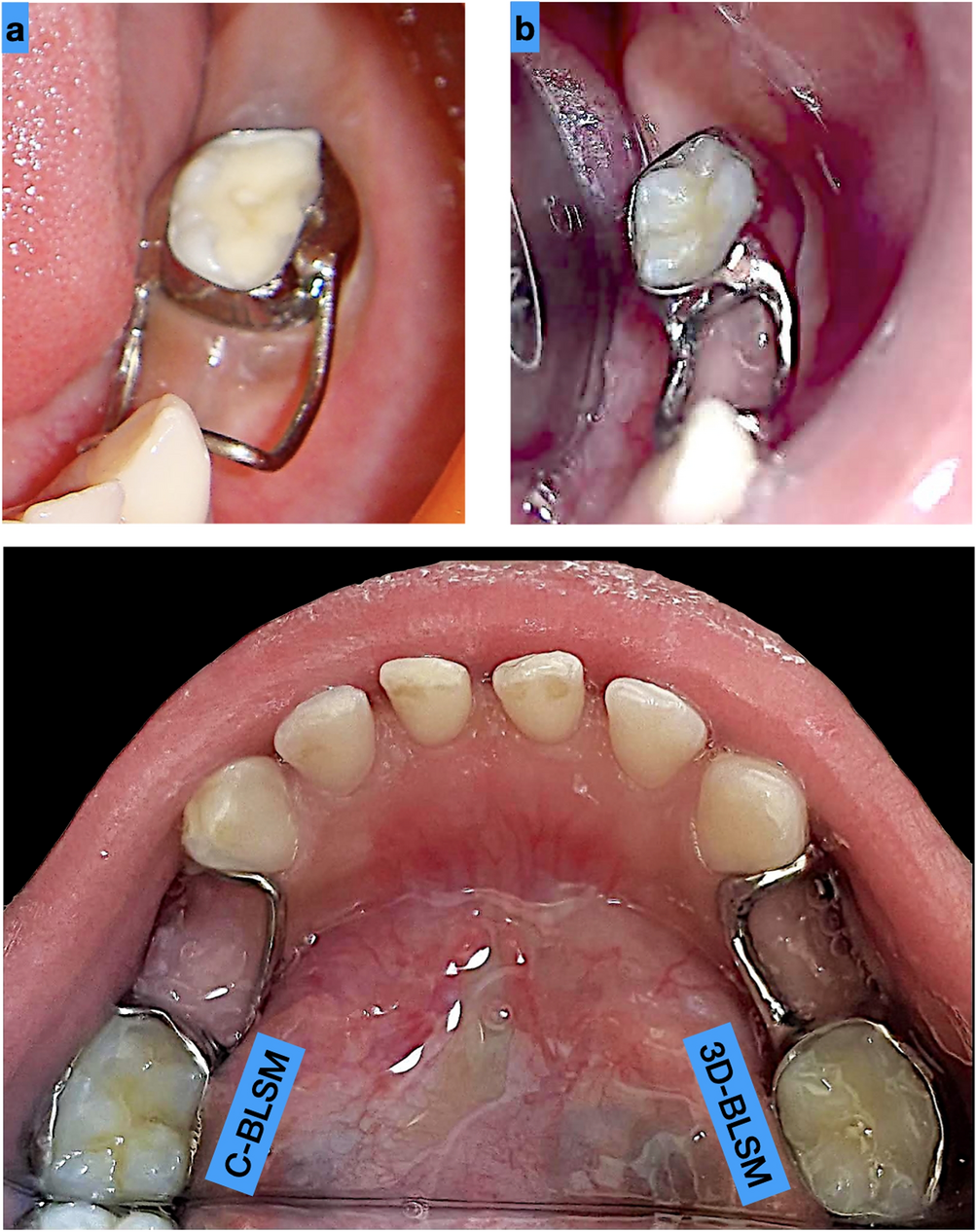 Pediatric Space Maintainer