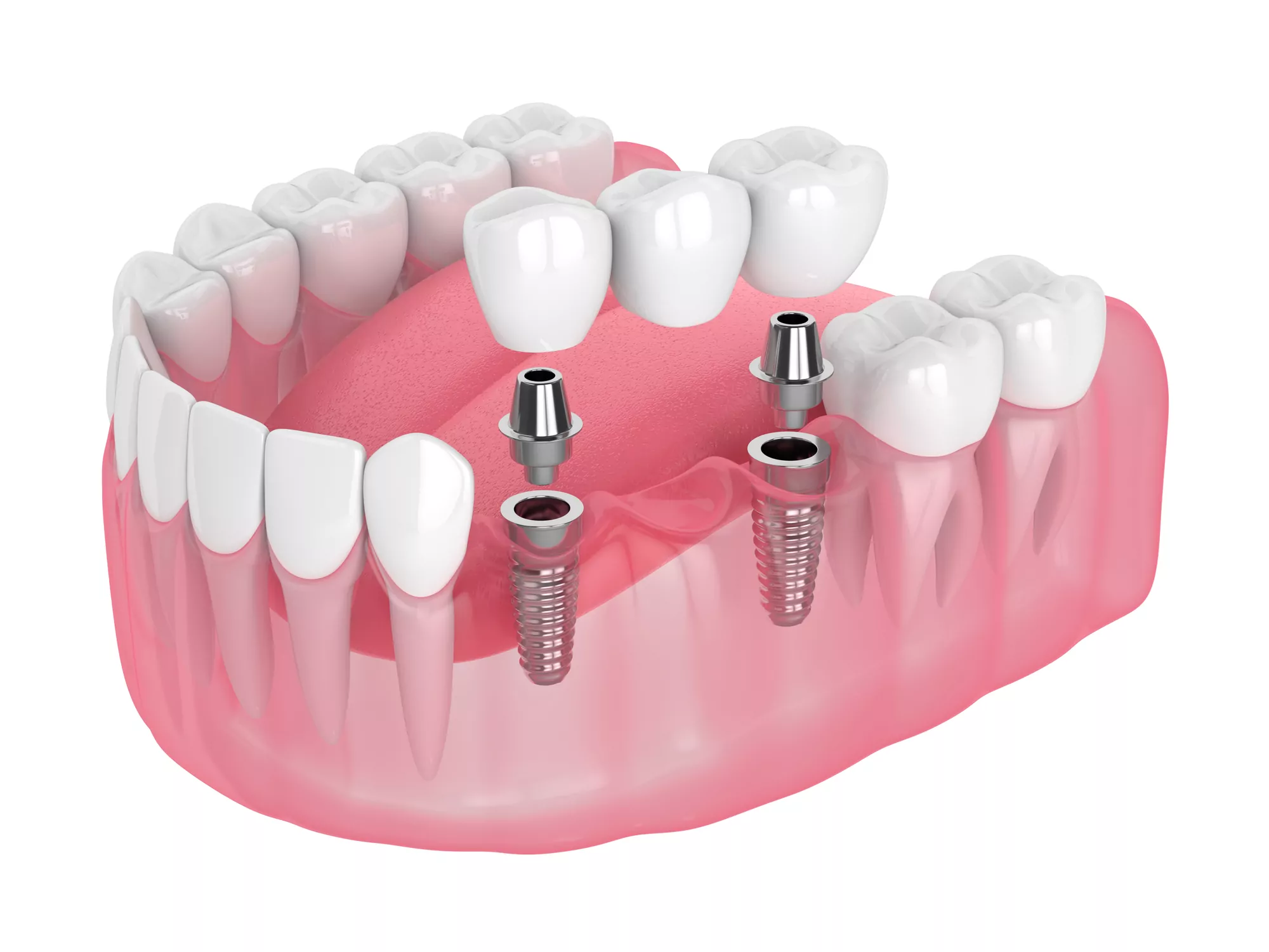 Crowns Bridges Dentures