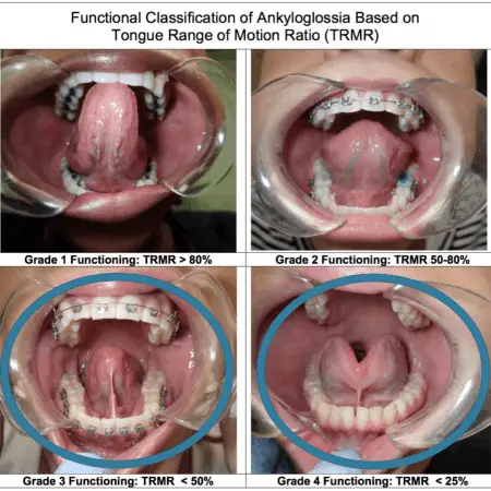 Tongue-tie Release Frenectomy