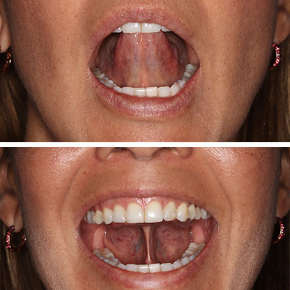 Myofunctional Therapy