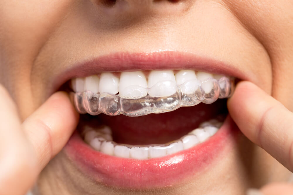 Short Term Orthodontics