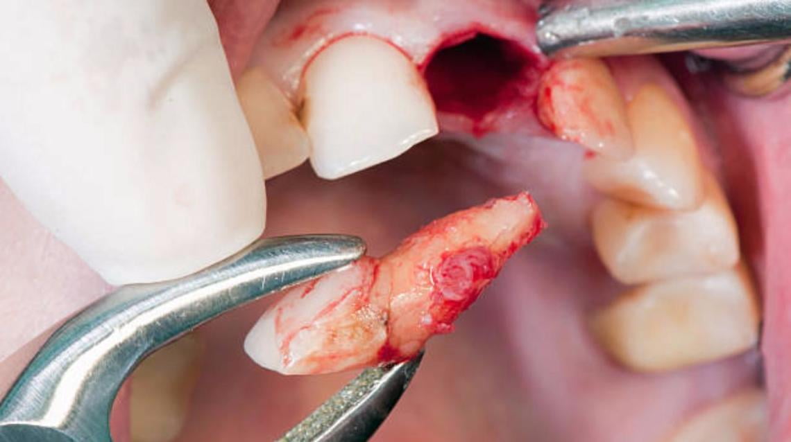 Tooth Extraction Oral Surgery