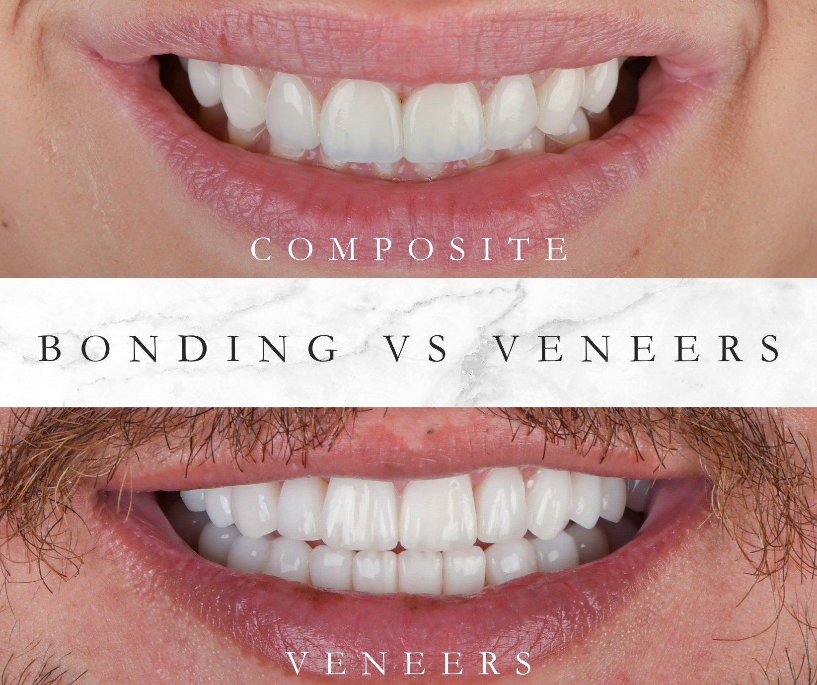Veneers Composite Bonding