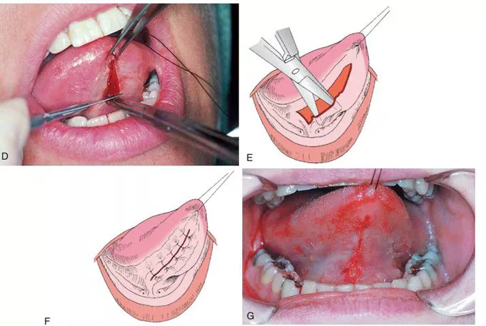 Frenum Release Procedure