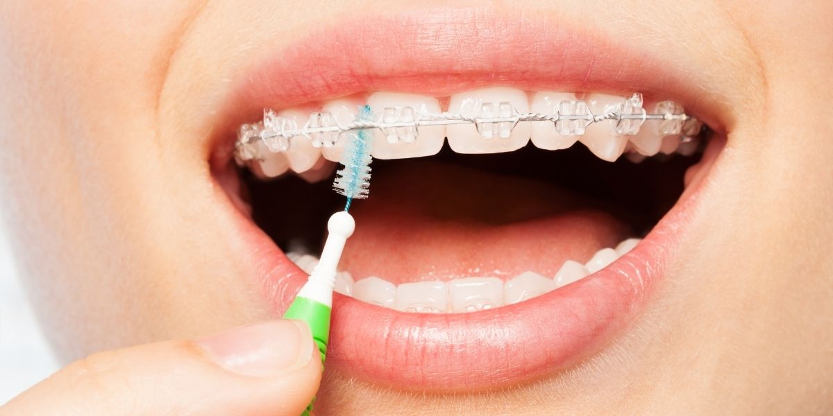 Interproximal Brushing Technique